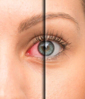 синдром сухого глаза капли